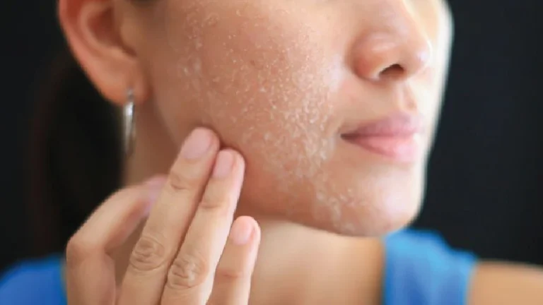 What Causes Dry Skin and How to Treat It