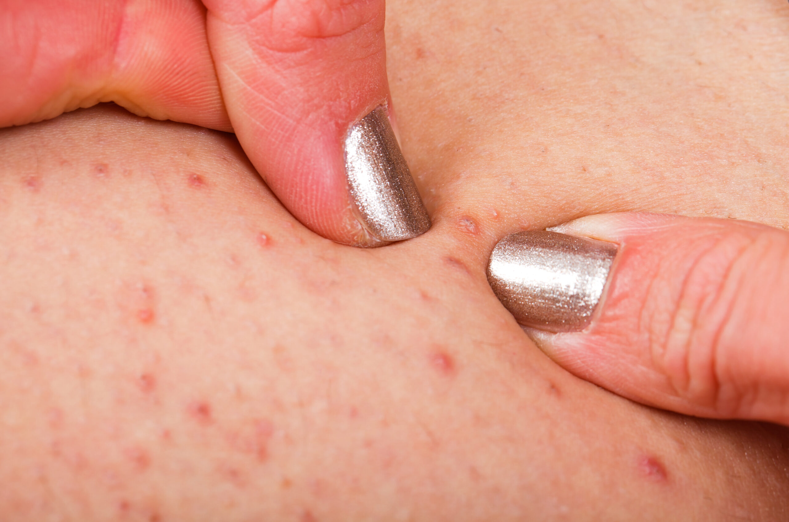 How to shave to avoid razor bumps